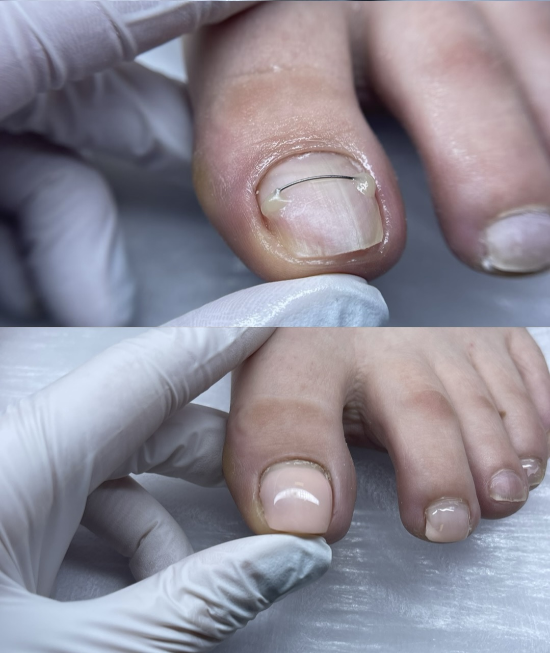 Pedichiură complexă: jos înainte de procedură, sus după corecția cu fir